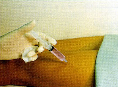 mesoterapia